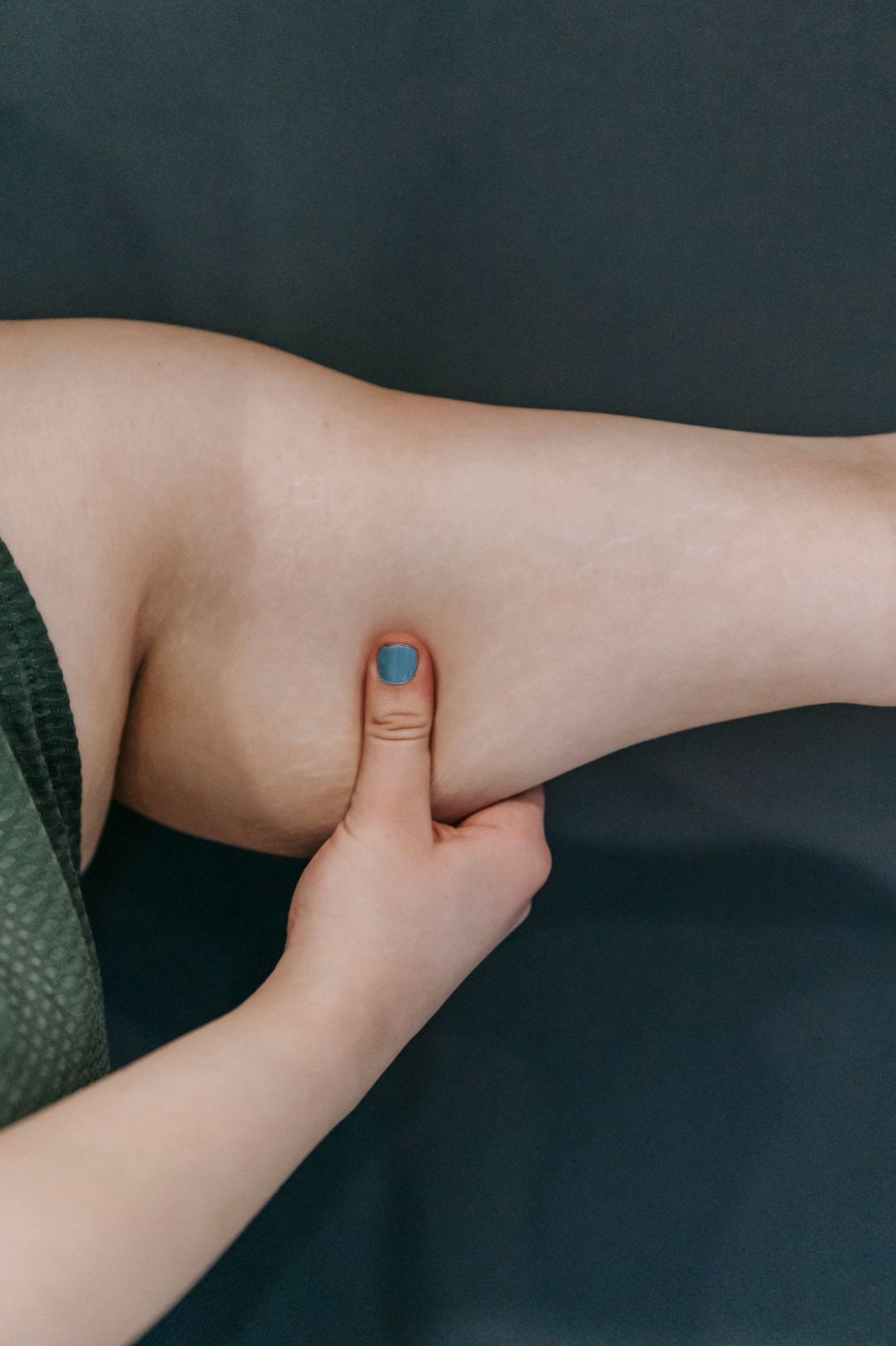 Clinician performing a pinch test to assess lipedema tissue